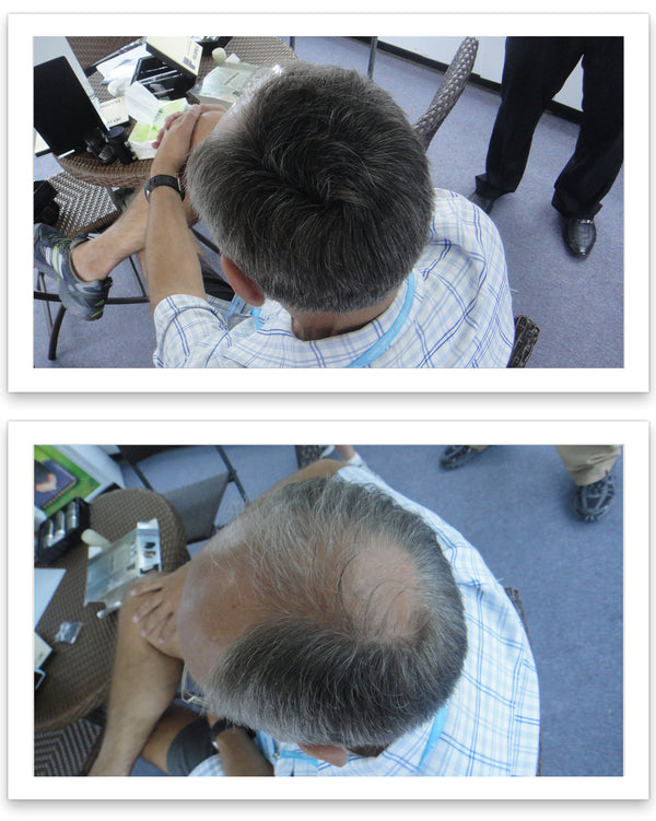 Before and after image of a man with a short straight black hair and a bald spot on his crown