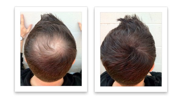 Before and after image of a man with short dark brown hair with a bald spot on his crown