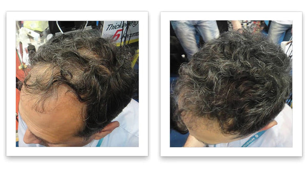 Before and after image of a man with short curly black and gray hair who has a receding hair line and a bald spot on his crown