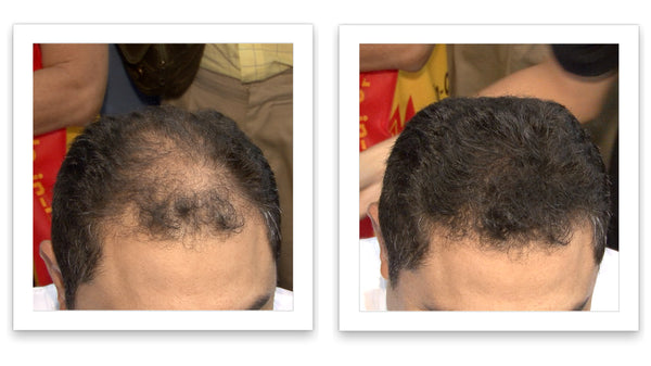 Before and after image of a man with short curly black hair with a bald spot on the crown and front scalp