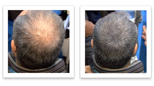 Before and after image of a man with short straight gray hair with a bald spot on his crown