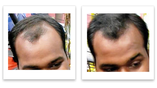 Before and after image of a man with short black hair and thin hair on his frontal scalp