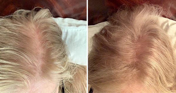 Before and after image of a woman with wavy blonde hair and thin hair on her crown and parting line