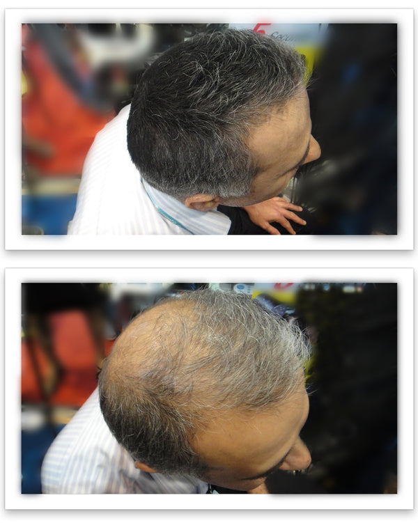 Before and after image of a man with short straight black/gray hair and a bald spot on his crown and thin hair on his frontal scalp