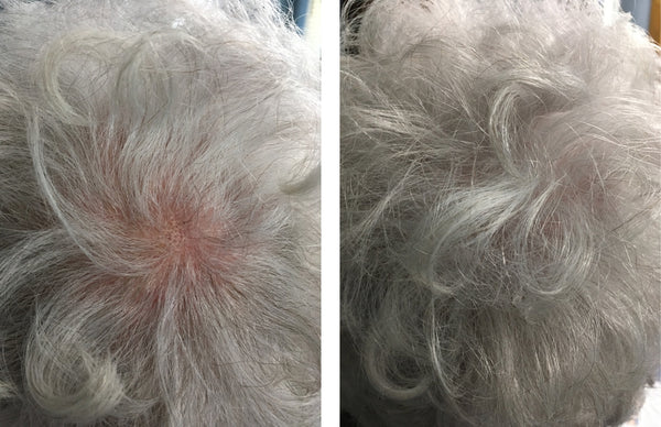 Before and after image of a person with curly white hair and a bald spot on their crown