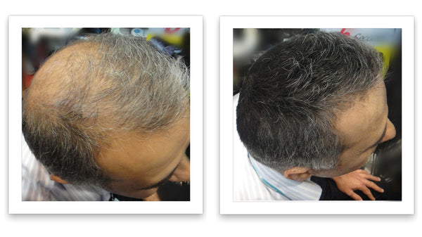 Before and after image of a man with short straight black/gray hair and a bald spot on his crown and thin hair on his frontal scalp