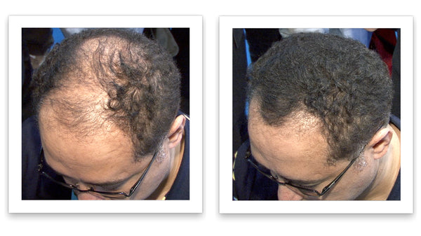 Before and after image of a man with short curly black hair that is thinning on the front and has a bald spot on his crown