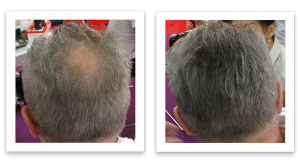 Before and after image of a man with short straight gray hair who has a bald spot on his crown