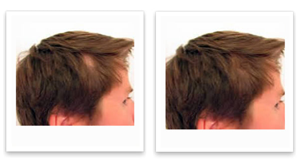 Before and after picture of a man with straight brown hair with a bald spot on the side of his head