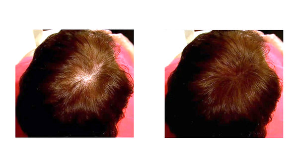 Before and after image of a woman with straight brown hair and a bald spot on her crown