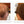 Before and after image of a man with thin brown hair on the crown and mid-scalp region
