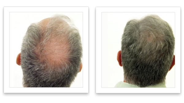 Before and after image of a man with short gray hair, a bald spot on his crown, and thin hair on his mid-scalp region