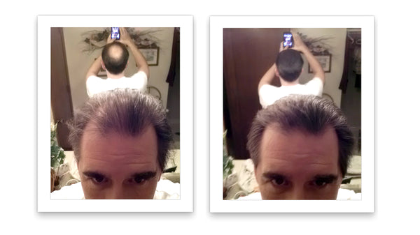 Before and after image of a man with straight brown hair and a slick back whose hair is thinning on his left side and on his crown