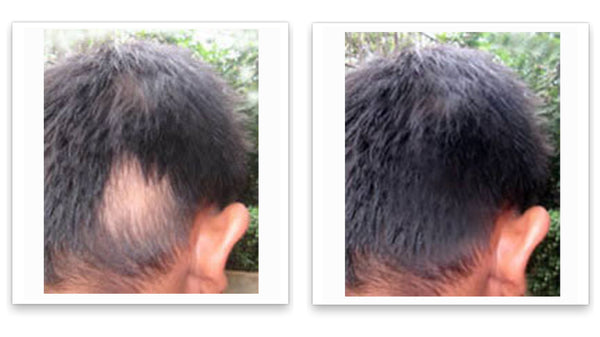 Before and after picture with straight short black hair and a bald spot on the back of his scalp near his ear