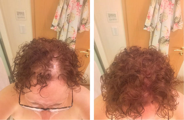 Before and after image of a person with short curly reddish-brown hair with thin hair on the crown