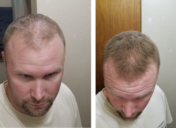 Before and after image of a man with short straight light brown hair whose hair is thinning on his frontal scalp
