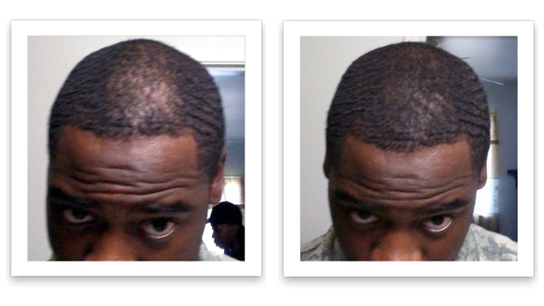 Before and after image of a man with short curly black hair and thin hair around his frontal scalp region