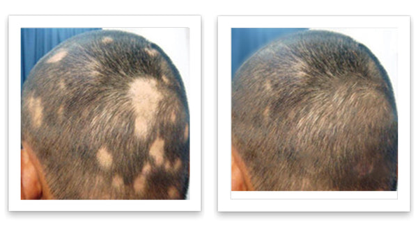 Before and after image of a man with very short straight black hair and bald spots all over the back of his head