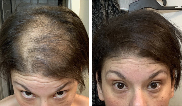 Before and after image of a woman with straight black hair and thin hair on the crown and frontal scalp