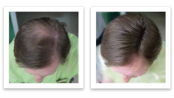 Before and after image of a man with straight brown hair with thin hair on his crown and parting line
