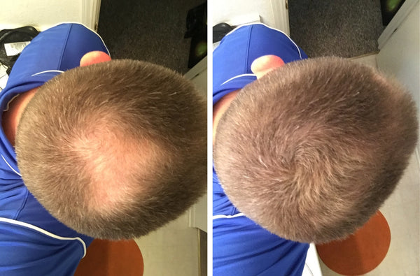 Before and after image of a man with short light brown hair with a bald spot on his crown