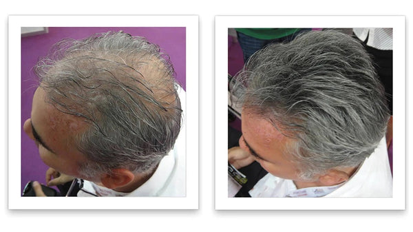 Before and after image of a man with short straight gray/white whose hair is thinning on his frontal scalp and has a bald spot on his crown