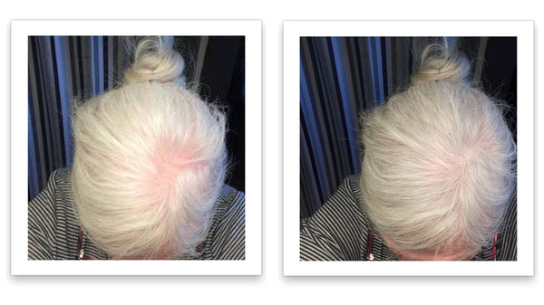 Before and after image of a woman with long straight white hair whose hair is thinning on her parting line and crown