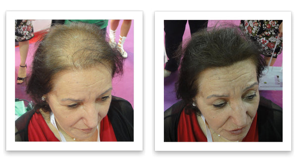 Before and after image of a woman with straight brown hair and a bald spot on her crown and front scalp