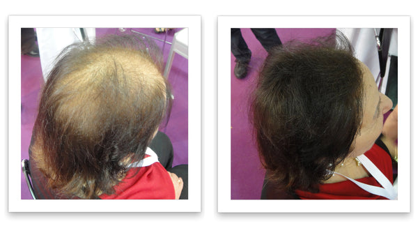 Before and after image of a woman with straight brown hair with a bald spot on her crown and frontal scalp